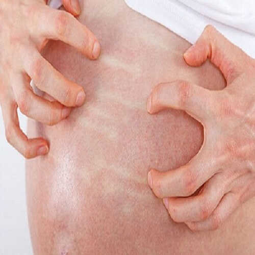 Ngứa ngáy, khó chịu